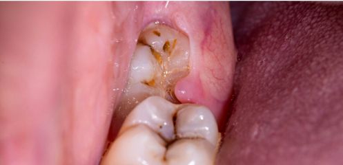 Impacted or infected wisdom teeth